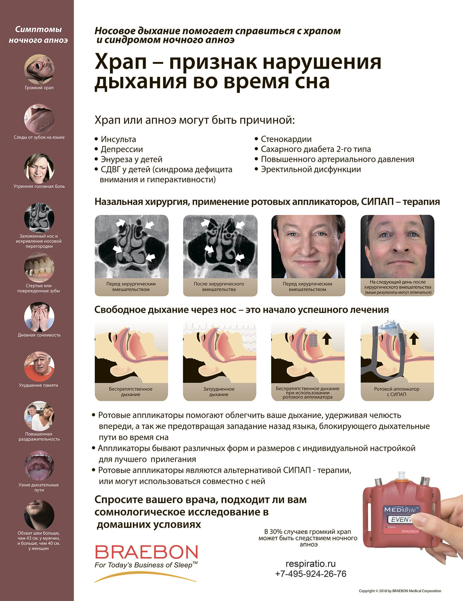 Храп – признак нарушения дыхания во время сна